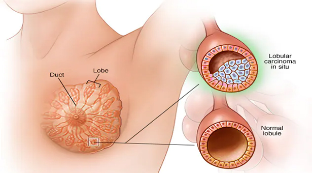 স্তন ক্যান্সার: ঝুঁকি যেভাবে কমানো যায়