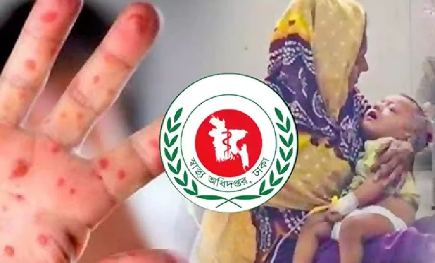 হাম ও উপসর্গে আরও ৫ শিশুর মৃত্যু, আক্রান্ত বাড়ছেই
