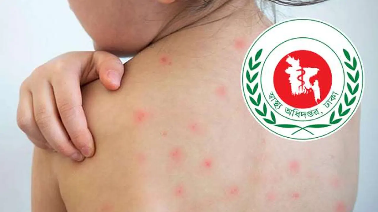 ৮৯ দিনে হাম ও উপসর্গে ৬৪৩ জনের মৃত্যু 