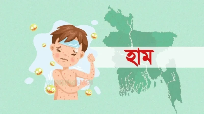 হাম উপসর্গে একদিনে ১১ শিশুর মৃত্যু